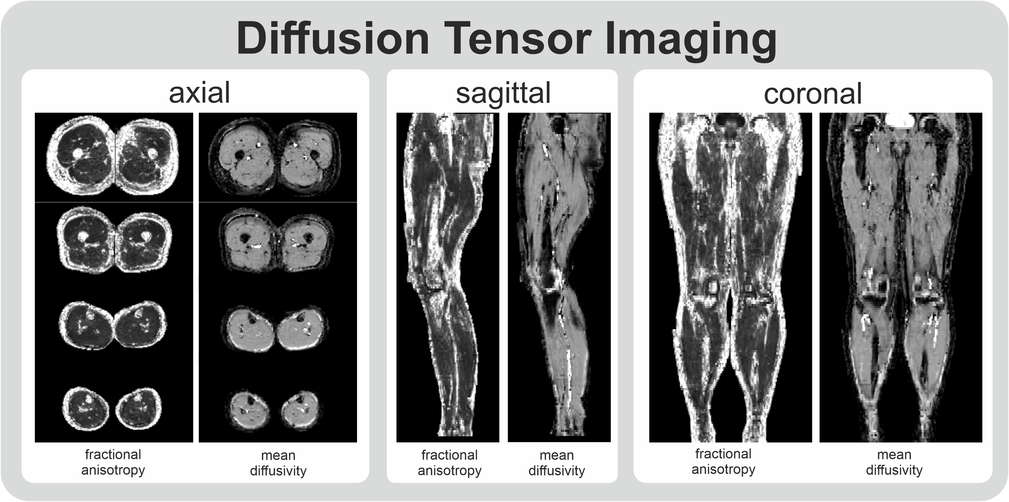 Whole leg diffusion tensor imaging of muscle