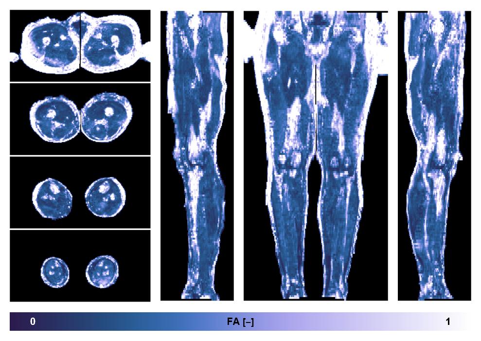 IVIM corrected whole leg muscle fractional anisotropy obtained from diffusion tensor imaging.
