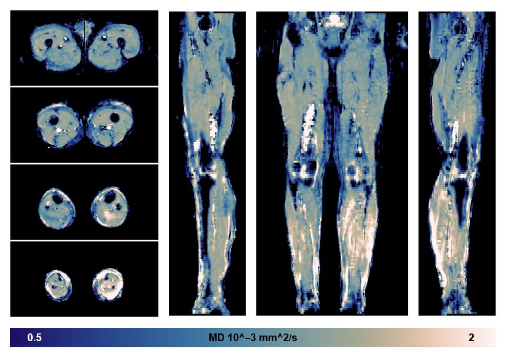 IVIM corrected whole leg muscle mean diffusivity obtained from diffusion tensor imaging.