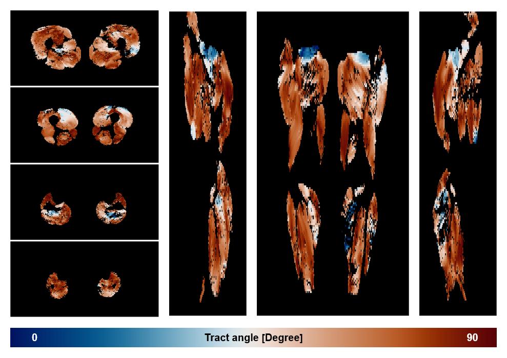 Muscle fiber tract angle map based on whole leg DTI based fiber tractography.