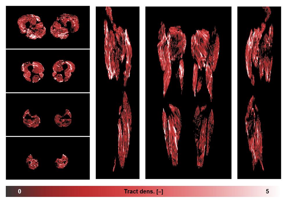 Muscle fiber tract density map based on whole leg DTI based fiber tractography.