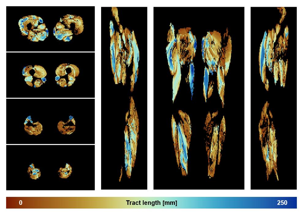Muscle fiber tract length map based on whole leg DTI based fiber tractography.