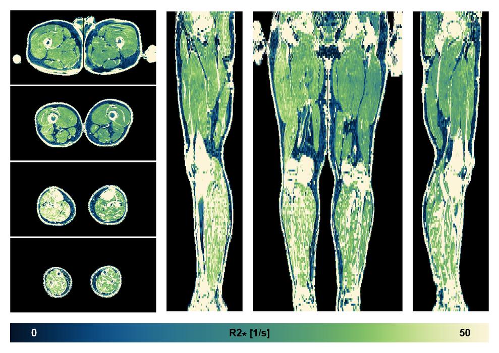 The R2 star relaxation time of the lower extremity obtained from the dixon reconstruction for muscle water fat quantification.