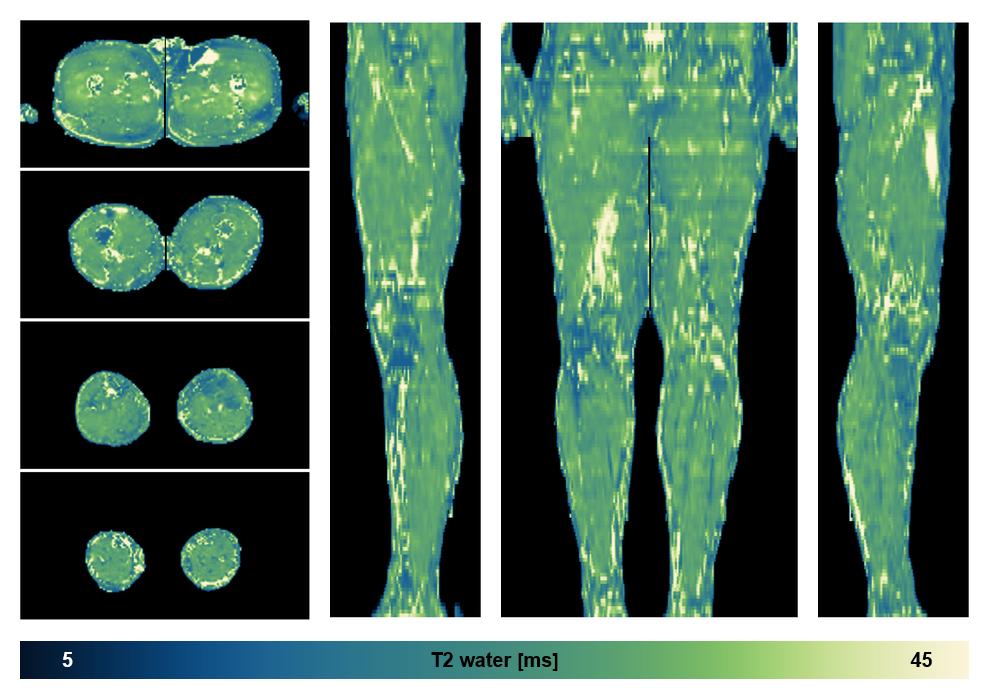 The water only T2 relaxation time of the lower extremity obtained from multi echo spin echo t2 mapping with EPG based reconstruction.