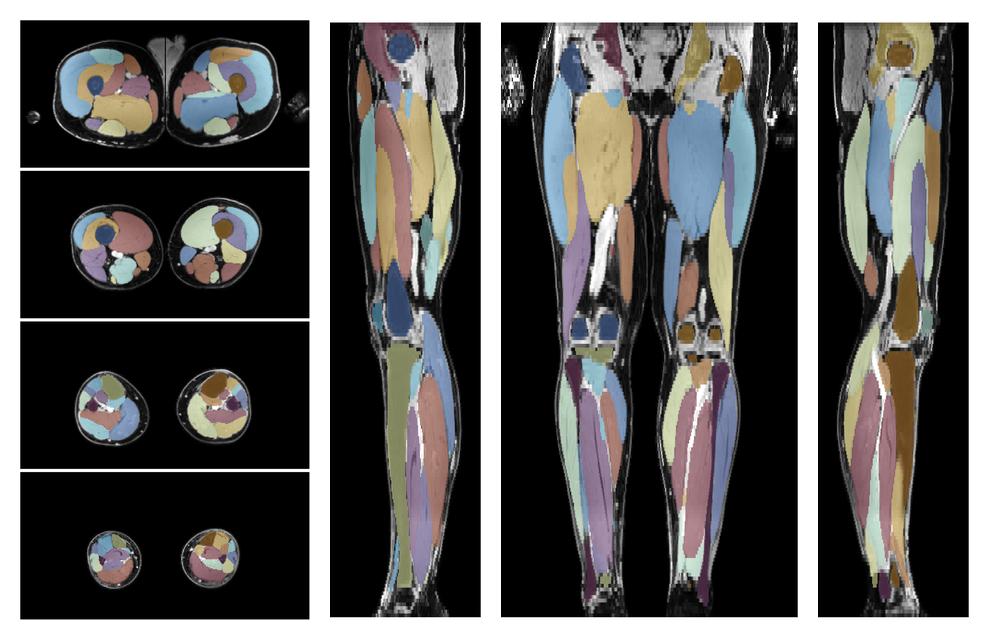 Overlay of automated muscle segmentation labels on dixon water image.