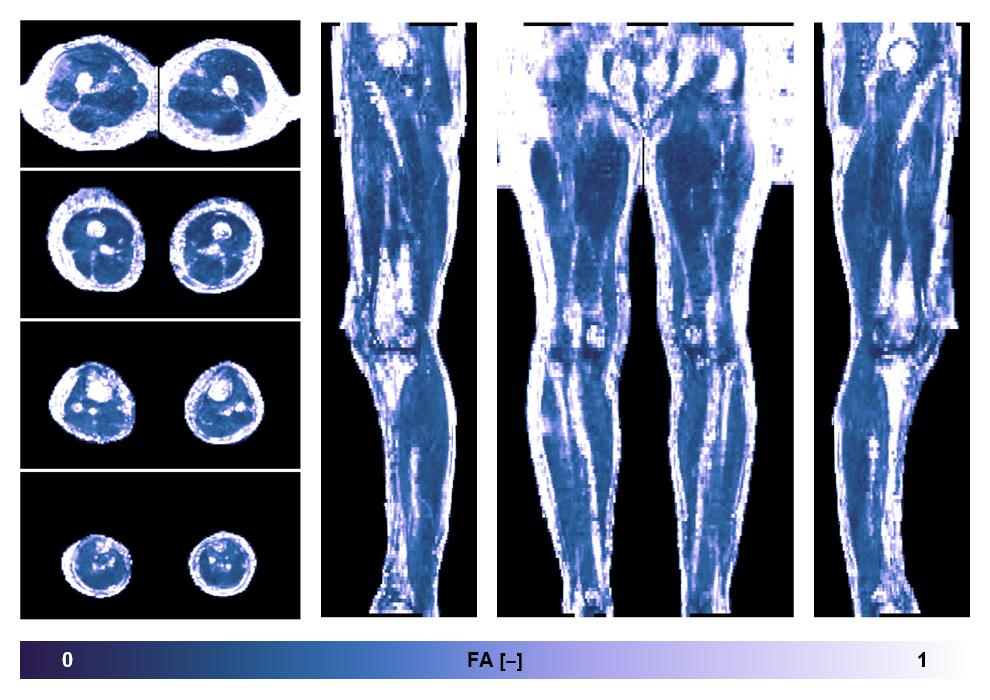 IVIM corrected whole leg muscle fractional anisotropy obtained from diffusion tensor imaging.