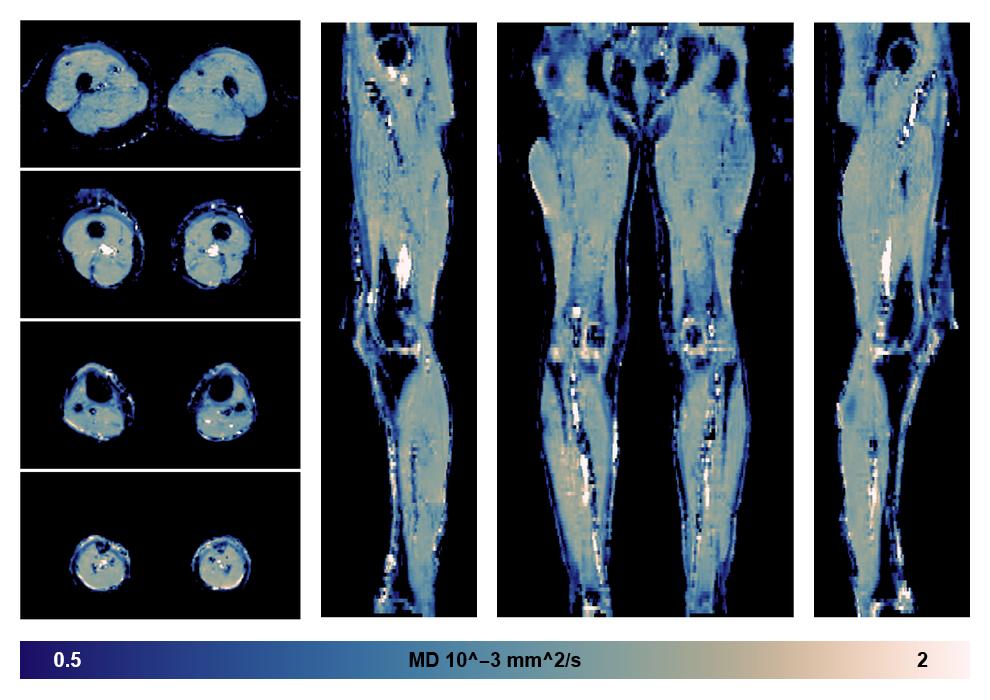 IVIM corrected whole leg muscle mean diffusivity obtained from diffusion tensor imaging.