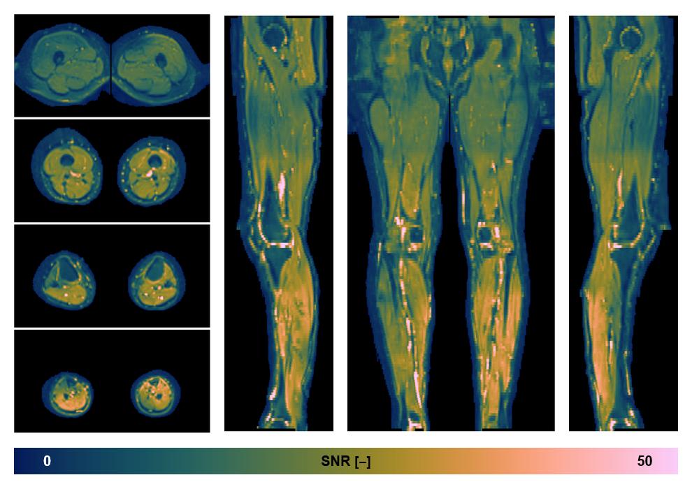 SNR distribution of the unweighted diffusion data.