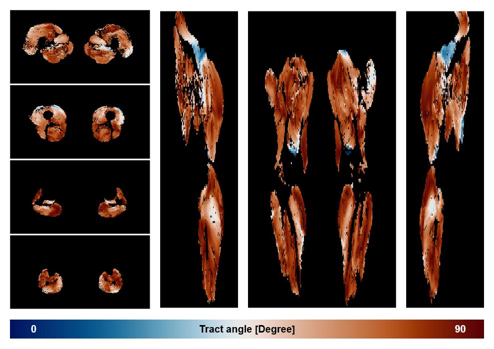 Muscle fiber tract angle map based on whole leg DTI based fiber tractography.