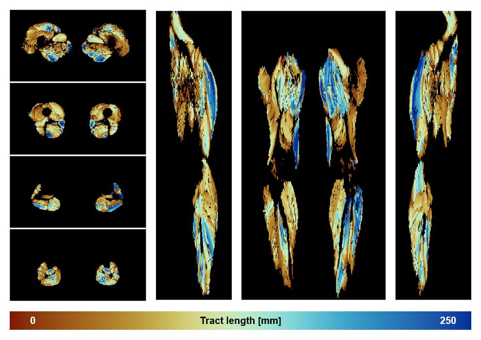 Muscle fiber tract length map based on whole leg DTI based fiber tractography.
