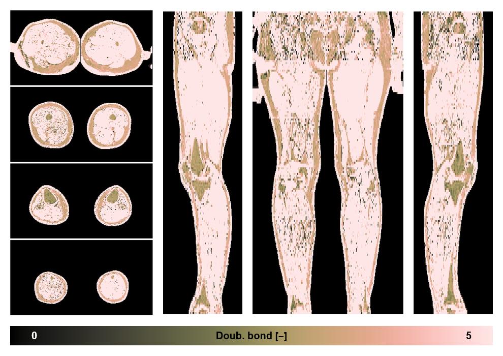 Number of double bonds in subcutanious fat.