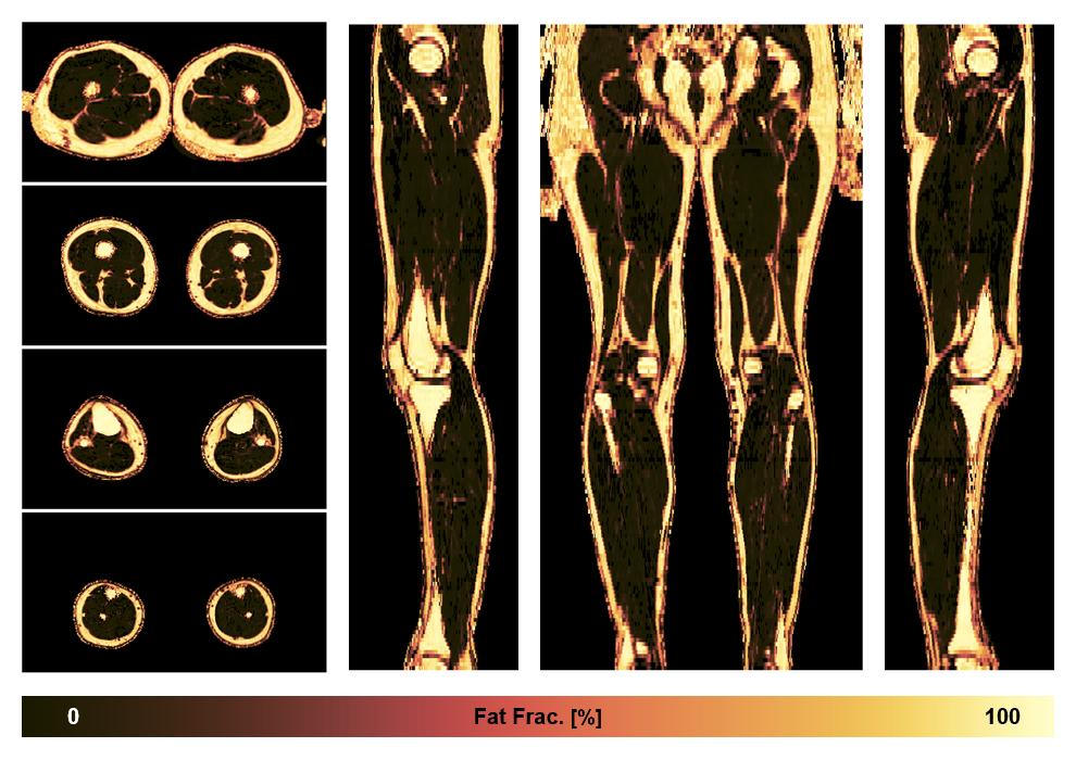 The fat fraction of the lower extremity obtained from the dixon reconstruction for muscle water fat quantification.