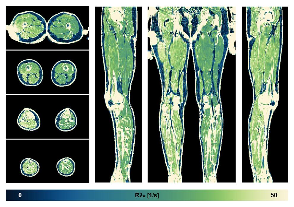 The R2 star relaxation time of the lower extremity obtained from the dixon reconstruction for muscle water fat quantification.
