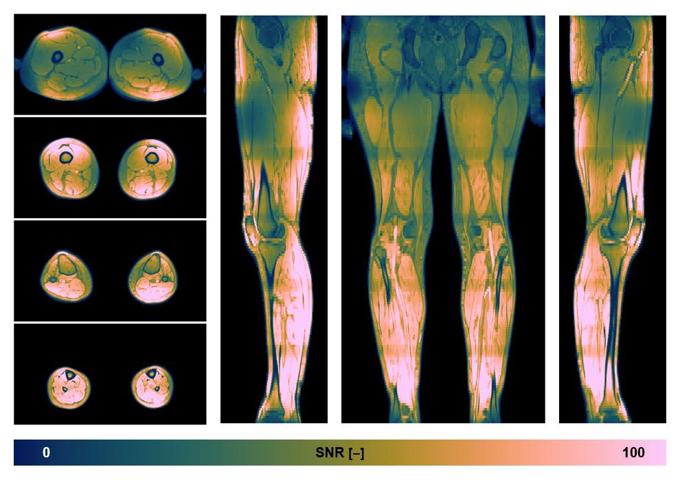 The SNR distribution of the dixon data.