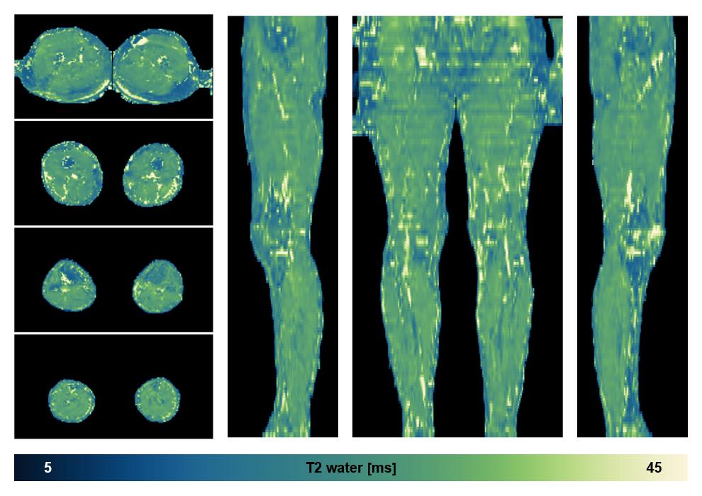 The water only T2 relaxation time of the lower extremity obtained from multi echo spin echo t2 mapping with EPG based reconstruction.