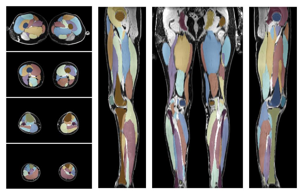 Overlay of automated muscle segmentation labels on dixon water image.