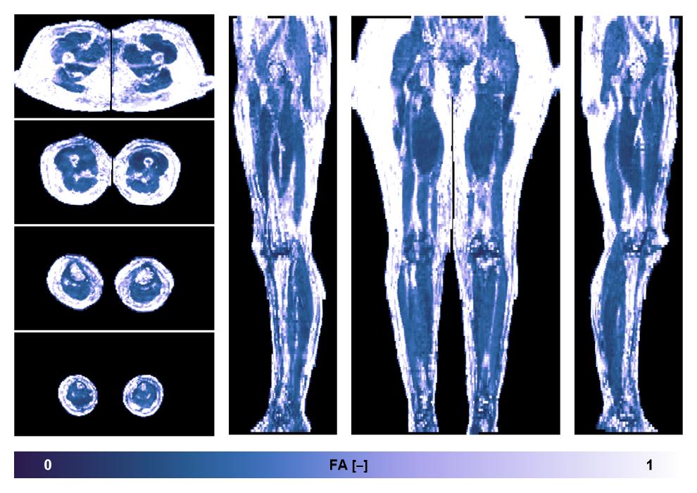 IVIM corrected whole leg muscle fractional anisotropy obtained from diffusion tensor imaging.