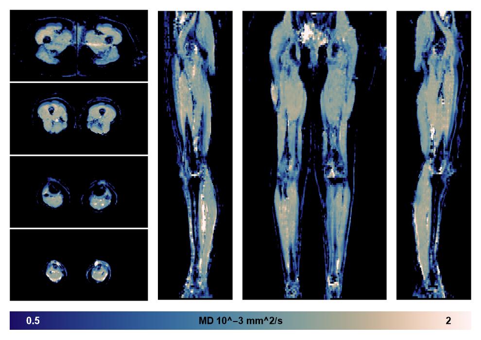 IVIM corrected whole leg muscle mean diffusivity obtained from diffusion tensor imaging.