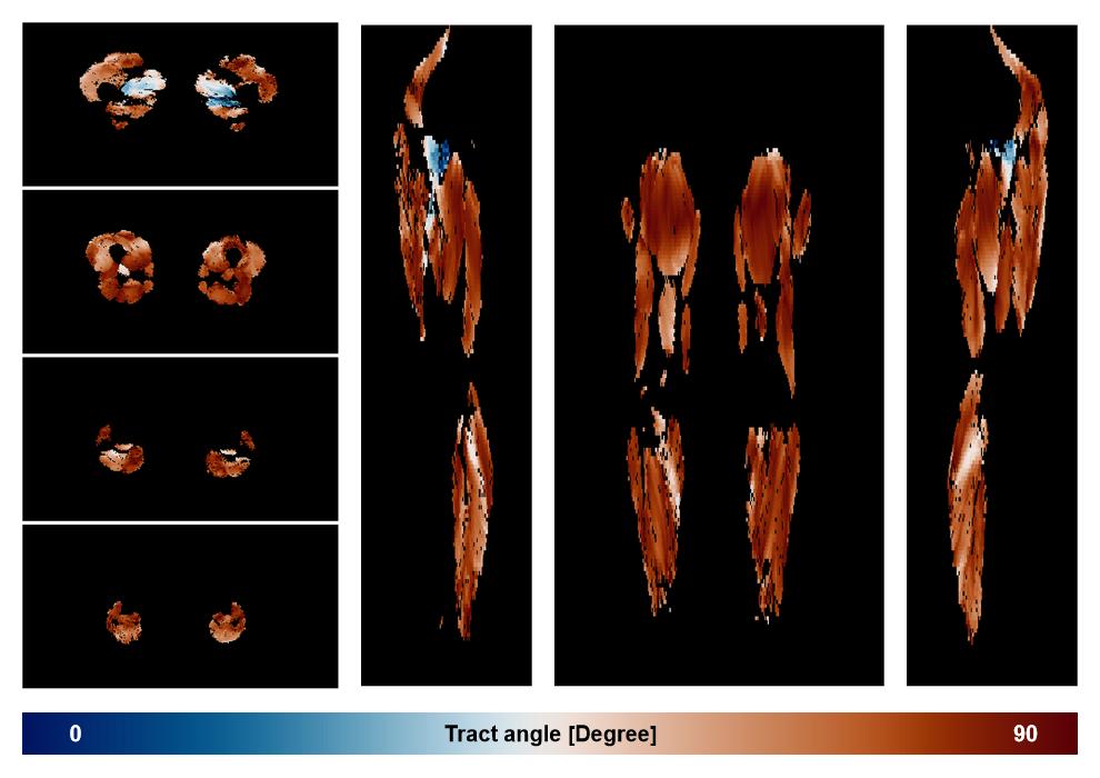 Muscle fiber tract angle map based on whole leg DTI based fiber tractography.
