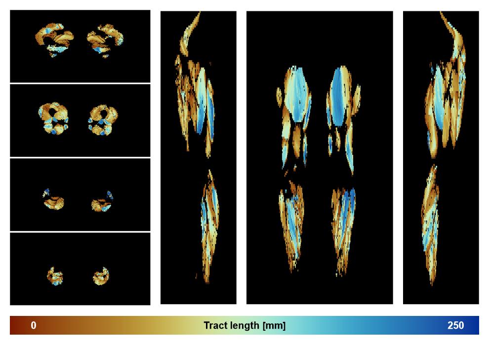 Muscle fiber tract length map based on whole leg DTI based fiber tractography.