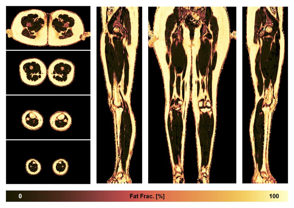 The fat fraction of the lower extremity obtained from the dixon reconstruction for muscle water fat quantification.