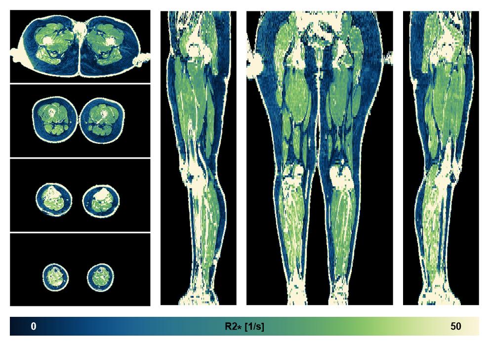 The R2 star relaxation time of the lower extremity obtained from the dixon reconstruction for muscle water fat quantification.