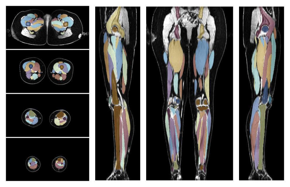 Overlay of automated muscle segmentation labels on dixon water image.
