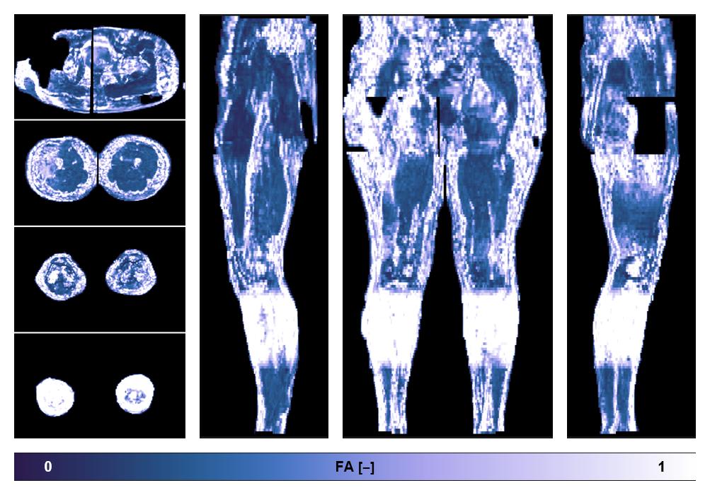 IVIM corrected whole leg muscle fractional anisotropy obtained from diffusion tensor imaging.