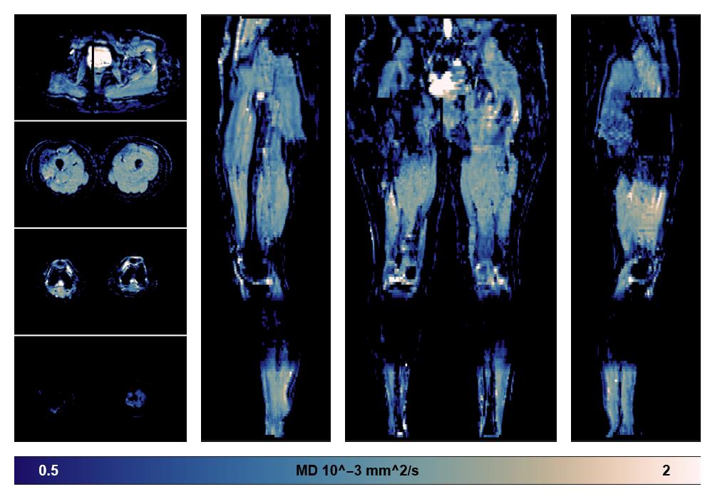 IVIM corrected whole leg muscle mean diffusivity obtained from diffusion tensor imaging.