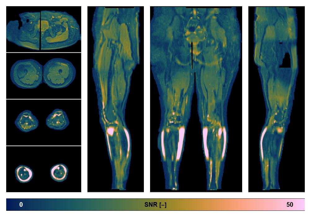 SNR distribution of the unweighted diffusion data.
