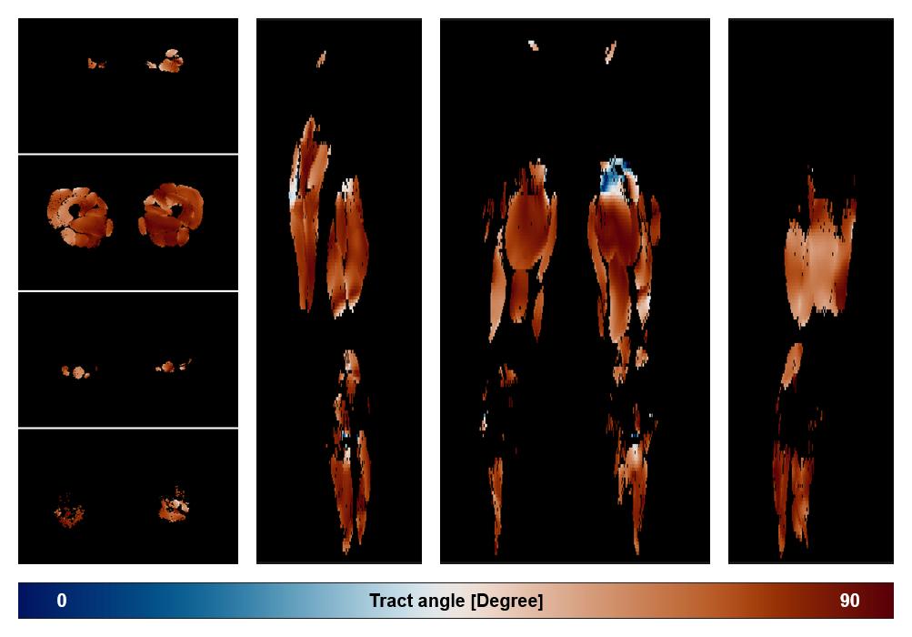 Muscle fiber tract angle map based on whole leg DTI based fiber tractography.