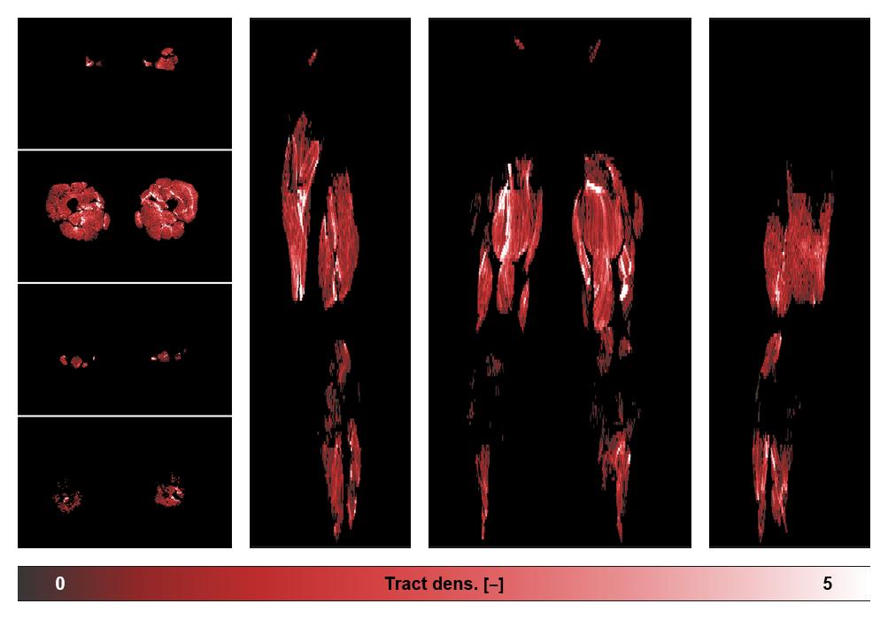 Muscle fiber tract density map based on whole leg DTI based fiber tractography.