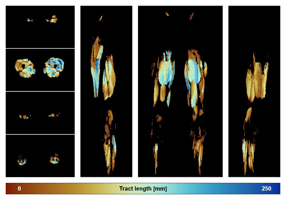 Muscle fiber tract length map based on whole leg DTI based fiber tractography.