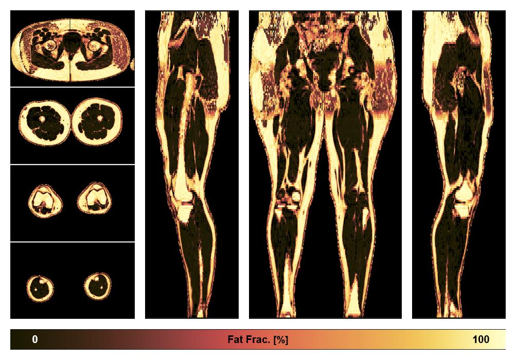The fat fraction of the lower extremity obtained from the dixon reconstruction for muscle water fat quantification.