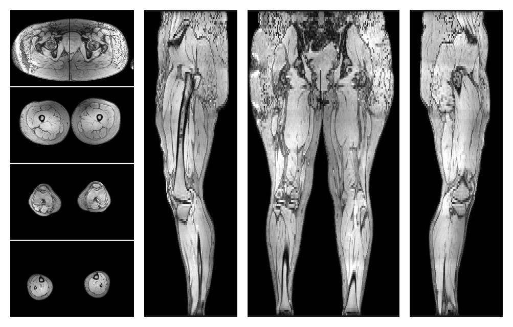 The out-phase image of the dixon reconstruction for water fat quantification.
