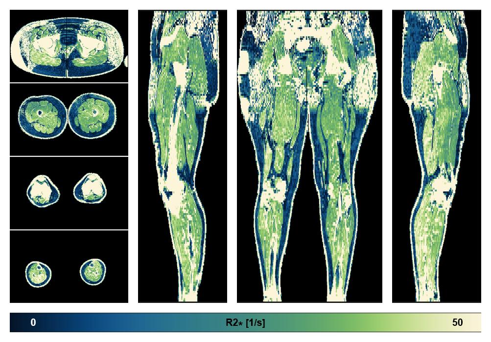 The R2 star relaxation time of the lower extremity obtained from the dixon reconstruction for muscle water fat quantification.