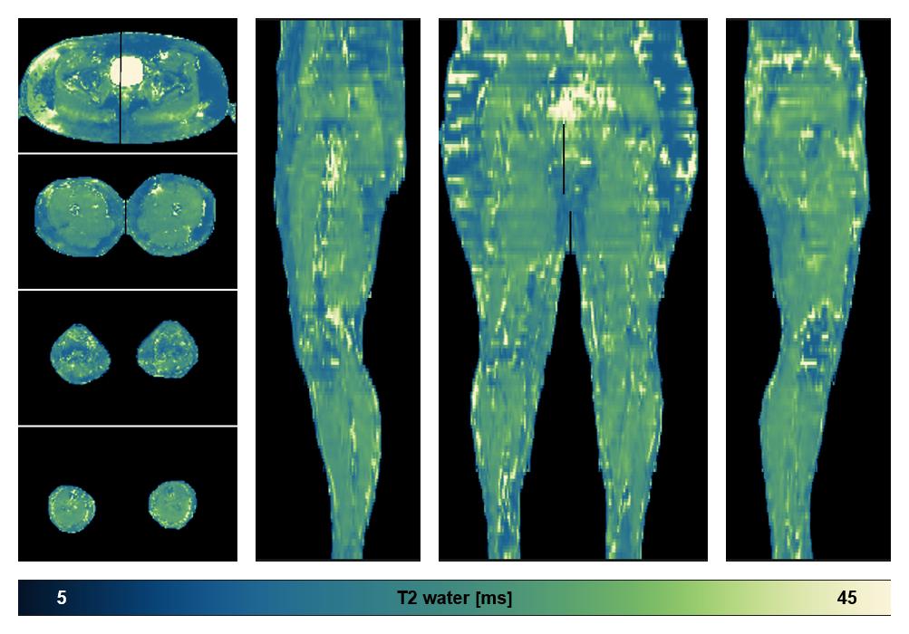 The water only T2 relaxation time of the lower extremity obtained from multi echo spin echo t2 mapping with EPG based reconstruction.
