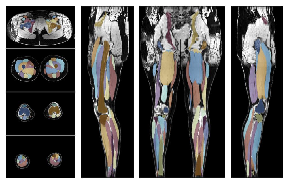 Overlay of automated muscle segmentation labels on dixon water image.