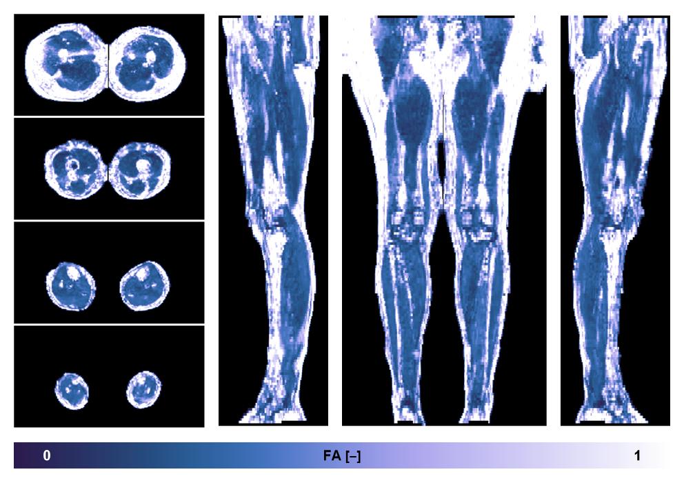 IVIM corrected whole leg muscle fractional anisotropy obtained from diffusion tensor imaging.