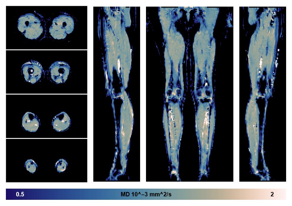 IVIM corrected whole leg muscle mean diffusivity obtained from diffusion tensor imaging.