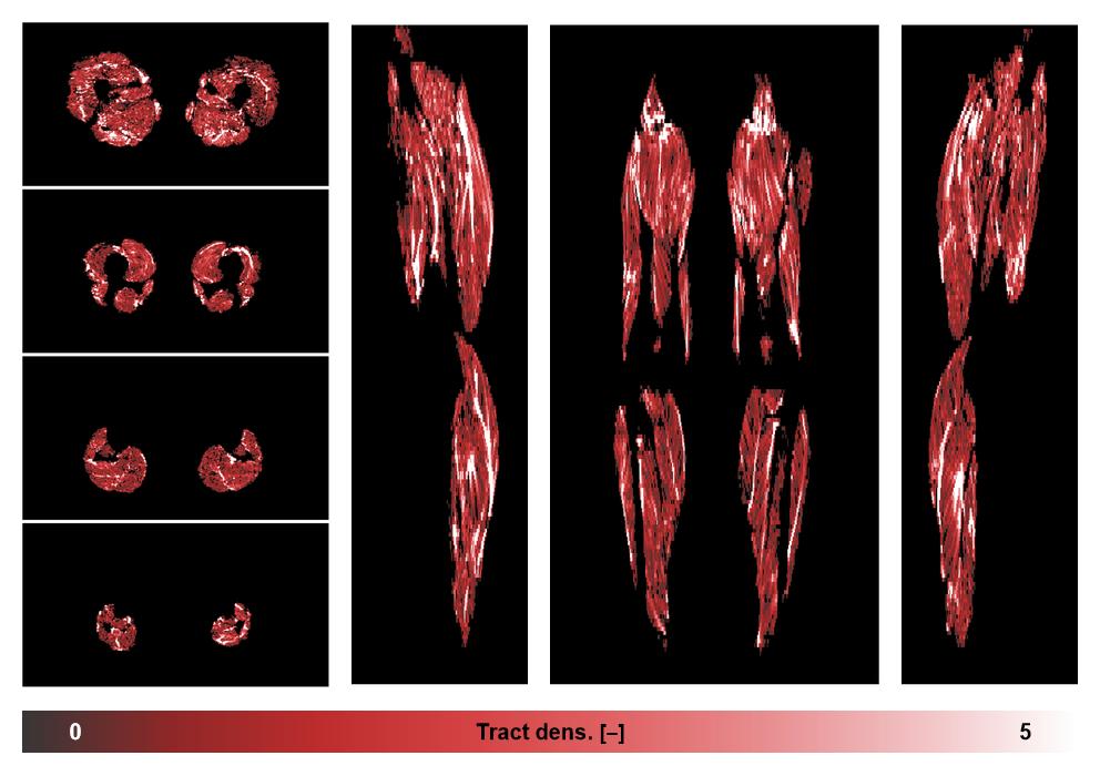 Muscle fiber tract density map based on whole leg DTI based fiber tractography.
