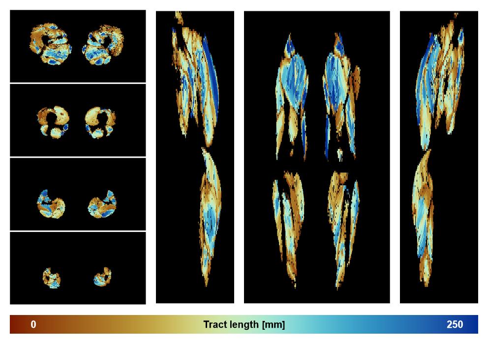 Muscle fiber tract length map based on whole leg DTI based fiber tractography.