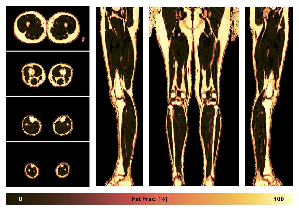The fat fraction of the lower extremity obtained from the dixon reconstruction for muscle water fat quantification.