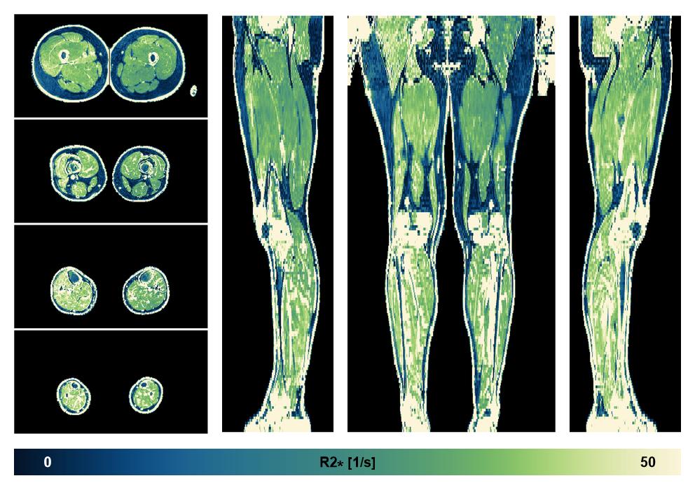 The R2 star relaxation time of the lower extremity obtained from the dixon reconstruction for muscle water fat quantification.