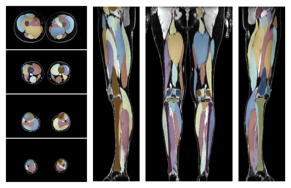 Overlay of automated muscle segmentation labels on dixon water image.