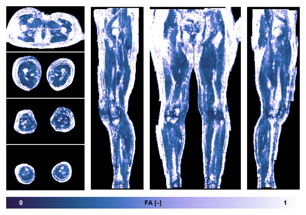 IVIM corrected whole leg muscle fractional anisotropy obtained from diffusion tensor imaging.