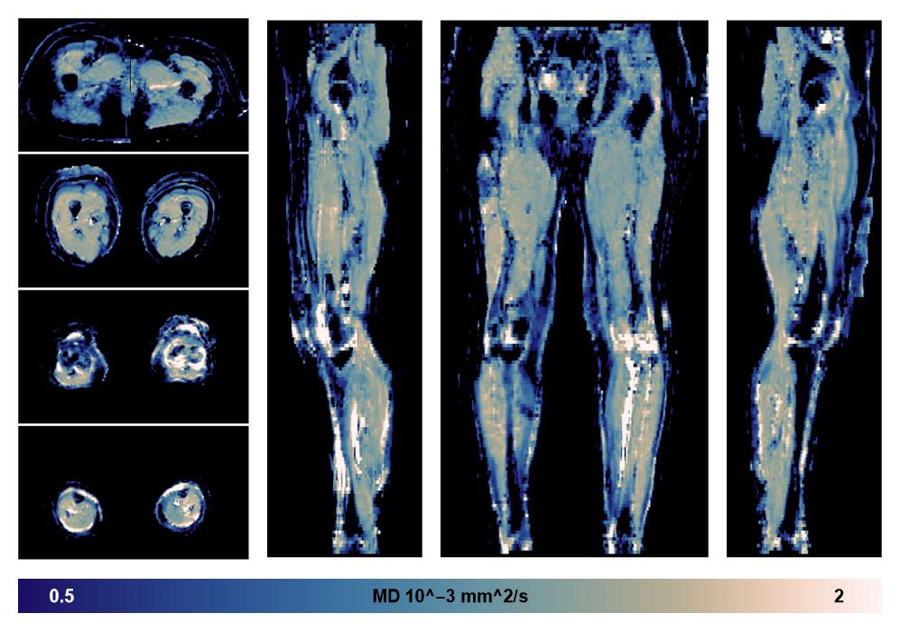 IVIM corrected whole leg muscle mean diffusivity obtained from diffusion tensor imaging.