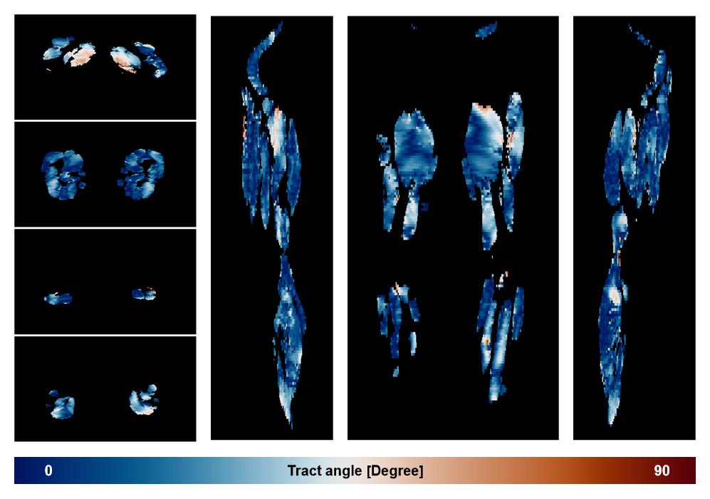 Muscle fiber tract angle map based on whole leg DTI based fiber tractography.