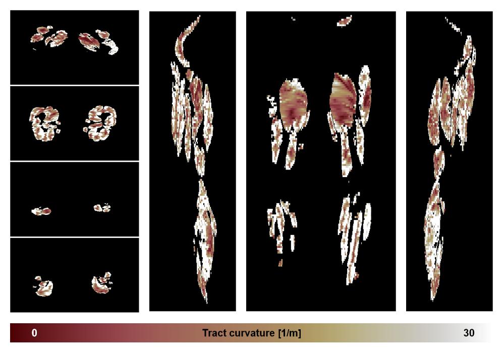 Muscle fiber tract curvature map based on whole leg DTI based fiber tractography.