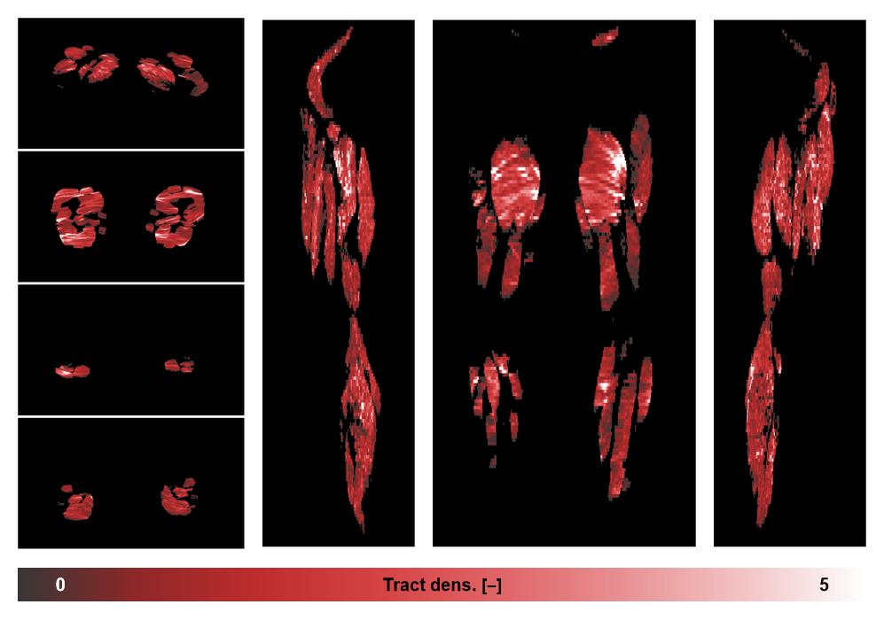 Muscle fiber tract density map based on whole leg DTI based fiber tractography.